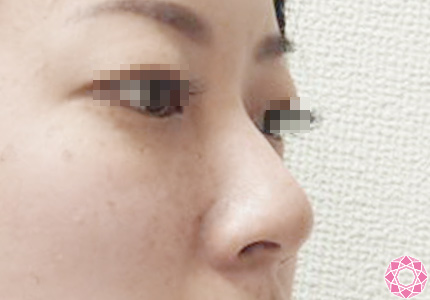 年代：20代 施術名：プチ隆鼻術（ヒアルロン酸） 施術前｜東京形成美容外科