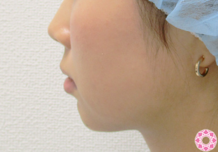 年代：20代 施術名：1DayクイックEライン 施術前｜東京形成美容外科